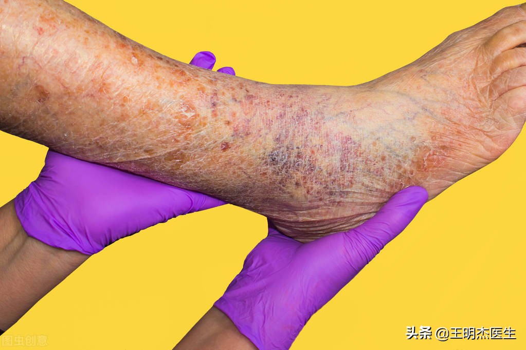 如何预防输液静脉炎的发生,静脉炎的护理方法有哪些呢