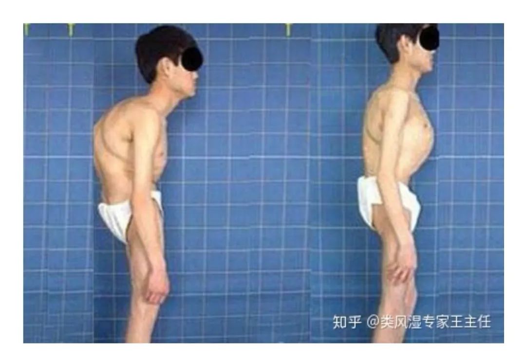 李宇春瘫痪坐轮椅综艺,李宇春自曝患脊柱炎有什么征兆