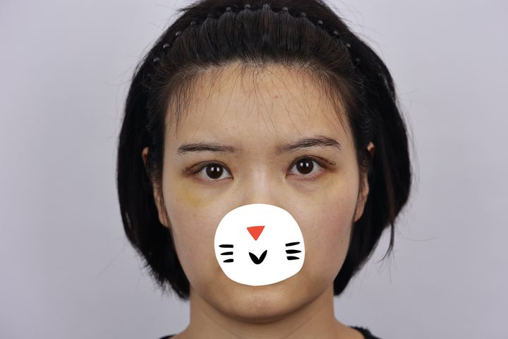 双眼皮术后大小眼是什么原因,双眼皮术后大小眼30天恢复图