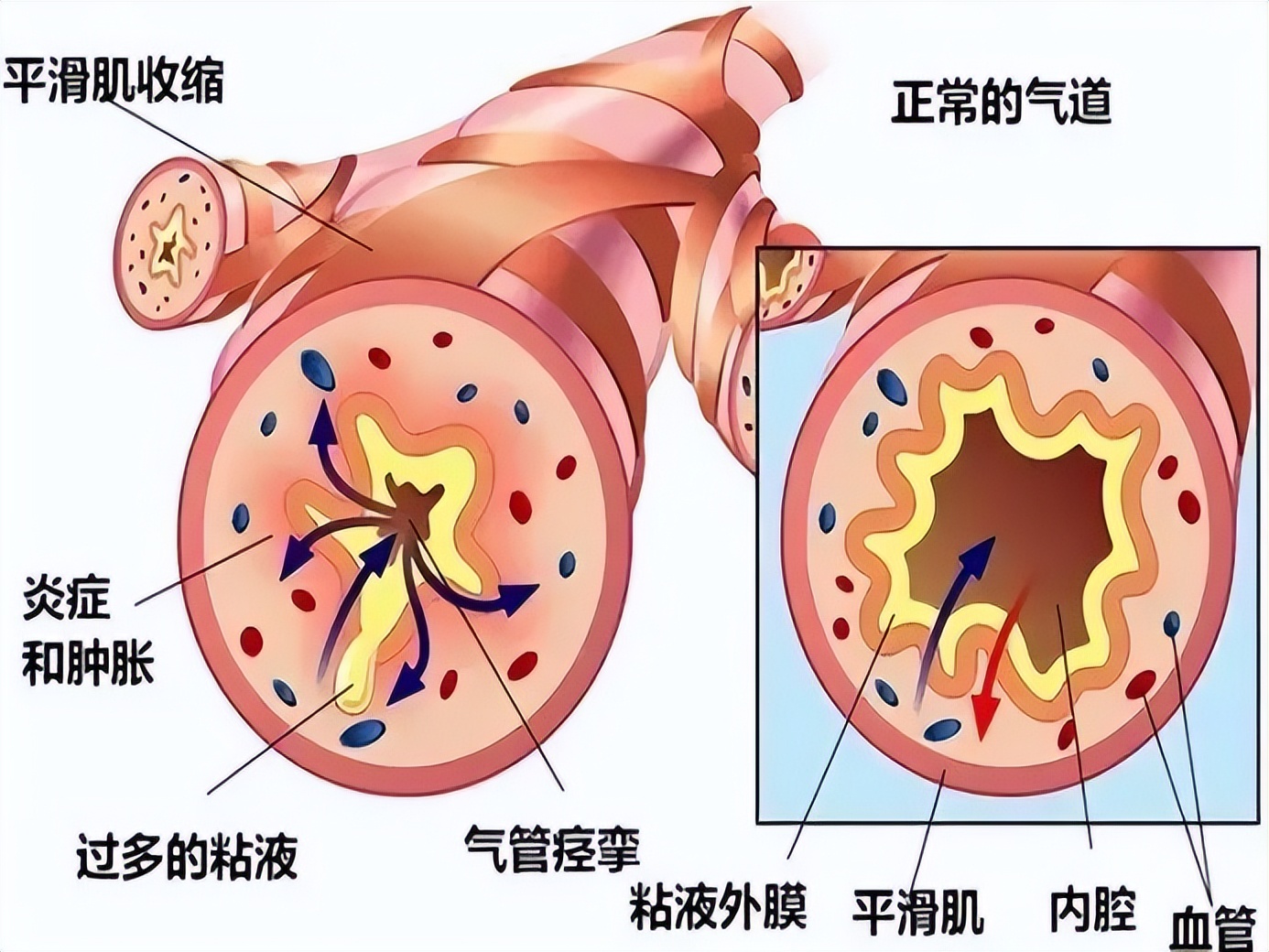 阿斯美复方甲氧那明胶囊消炎吗,阿斯美复方甲氧那明是抗生素药吗