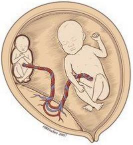 孕20周减胎成功率,多胎减胎几周前减最好