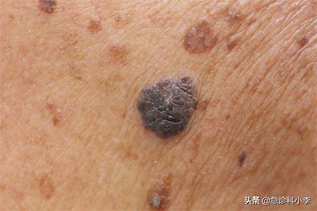 孩子身上小红点不痛不痒是什么病,身上起小红点不痛不痒按压会消失