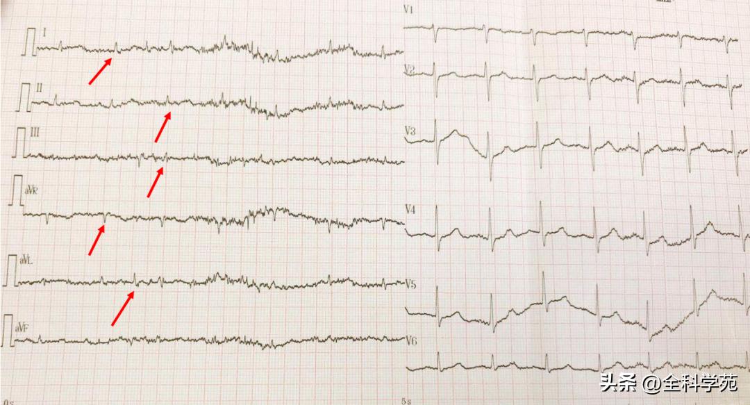心电图qrs时限超宽是什么引起的,心电图qrs波呈m型见于什么疾病