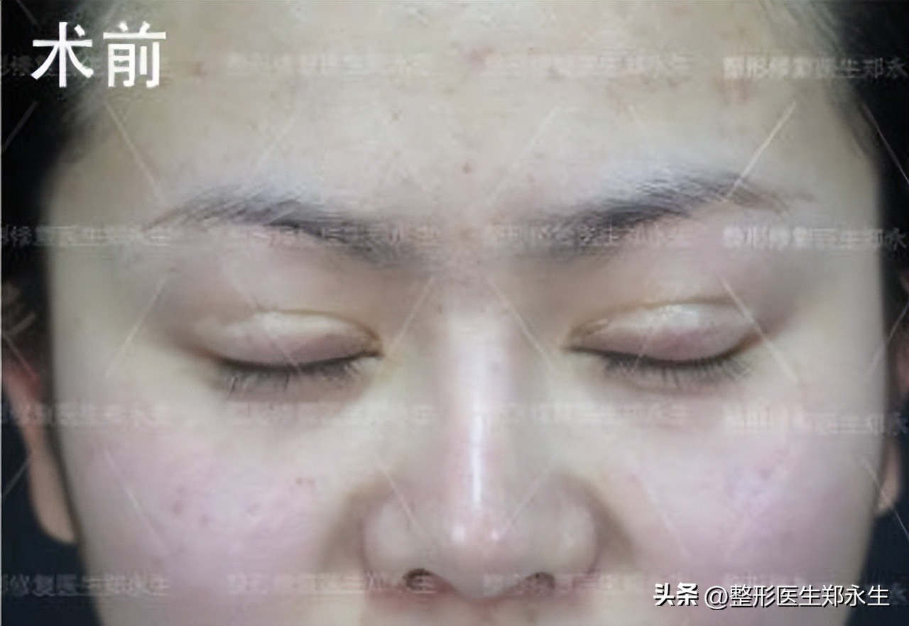 双眼皮修复手术真的很难吗,双眼皮整形真实修复过程