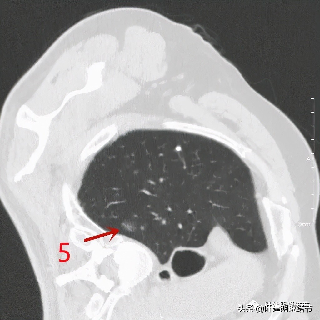 肺多发结节切除一个剩下的怎么办,无限纠结的肺小结节