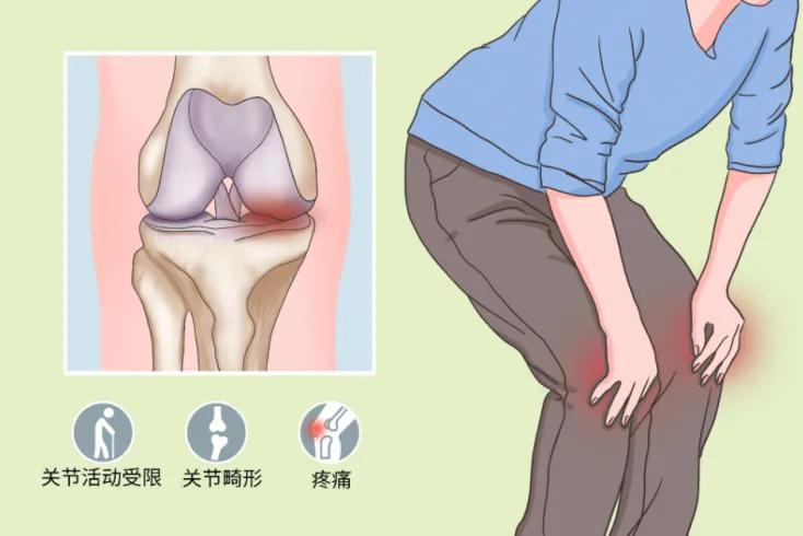 膝关节炎真的治不好吗,膝关节炎吃什么能补