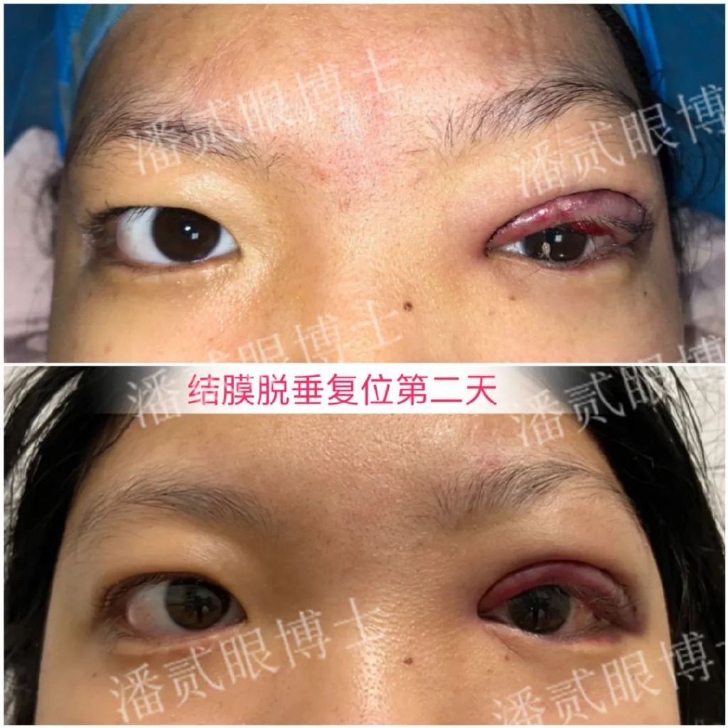 术后（重度上睑下垂）出现结膜脱垂怎么办？