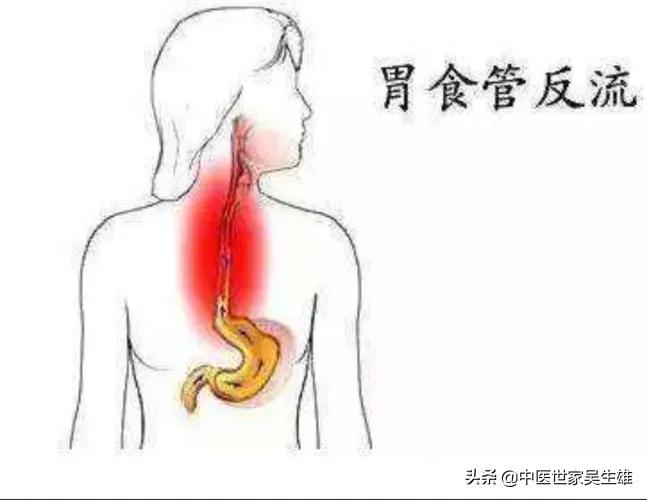 反流性食管炎久不治愈,反流食管炎老是治不好