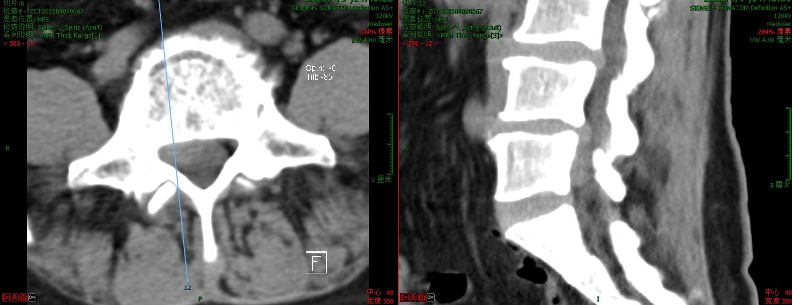 在中原地区正式开展！河南省洛阳正骨医院为两例腰椎疾病患者成功实施V形双通道脊柱内镜技术（VBE）