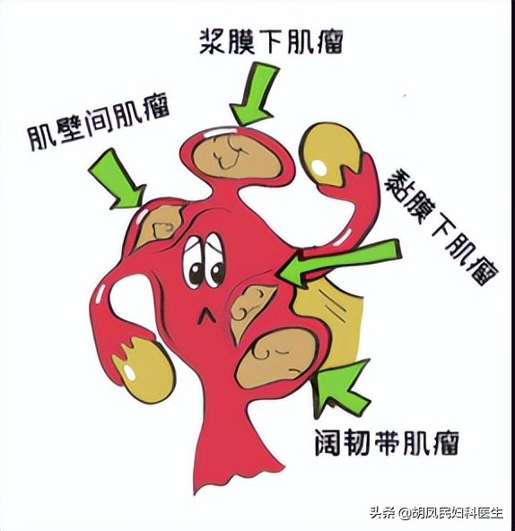 子宫肌瘤术后影响怀孕,子宫肌瘤7公分影响怀孕