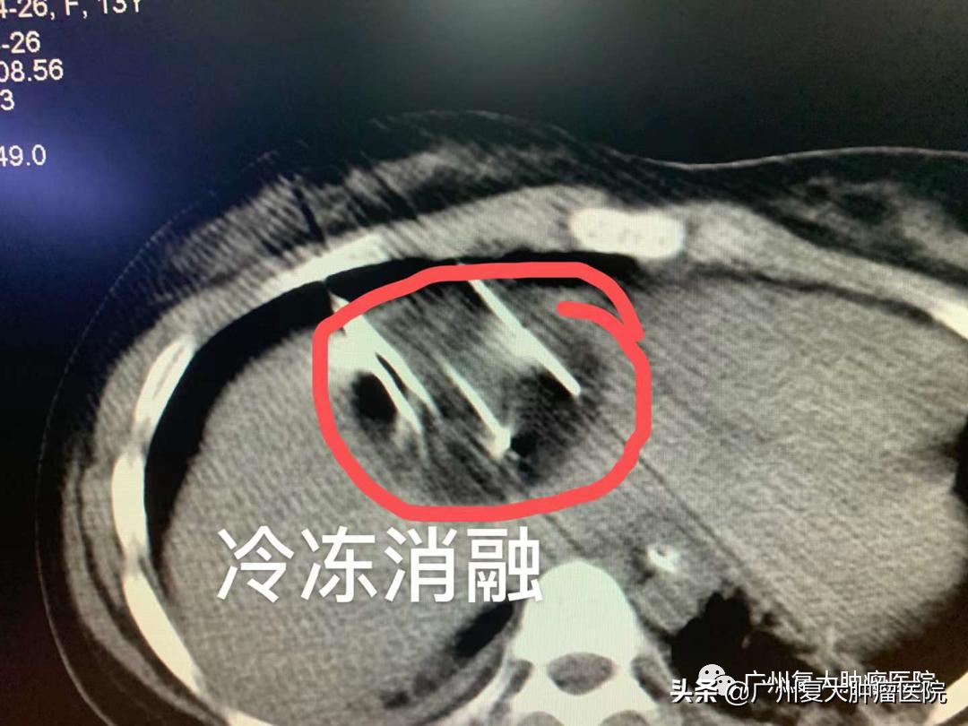 护士节特殊的礼物——来自病区13岁患者创作的手抄报