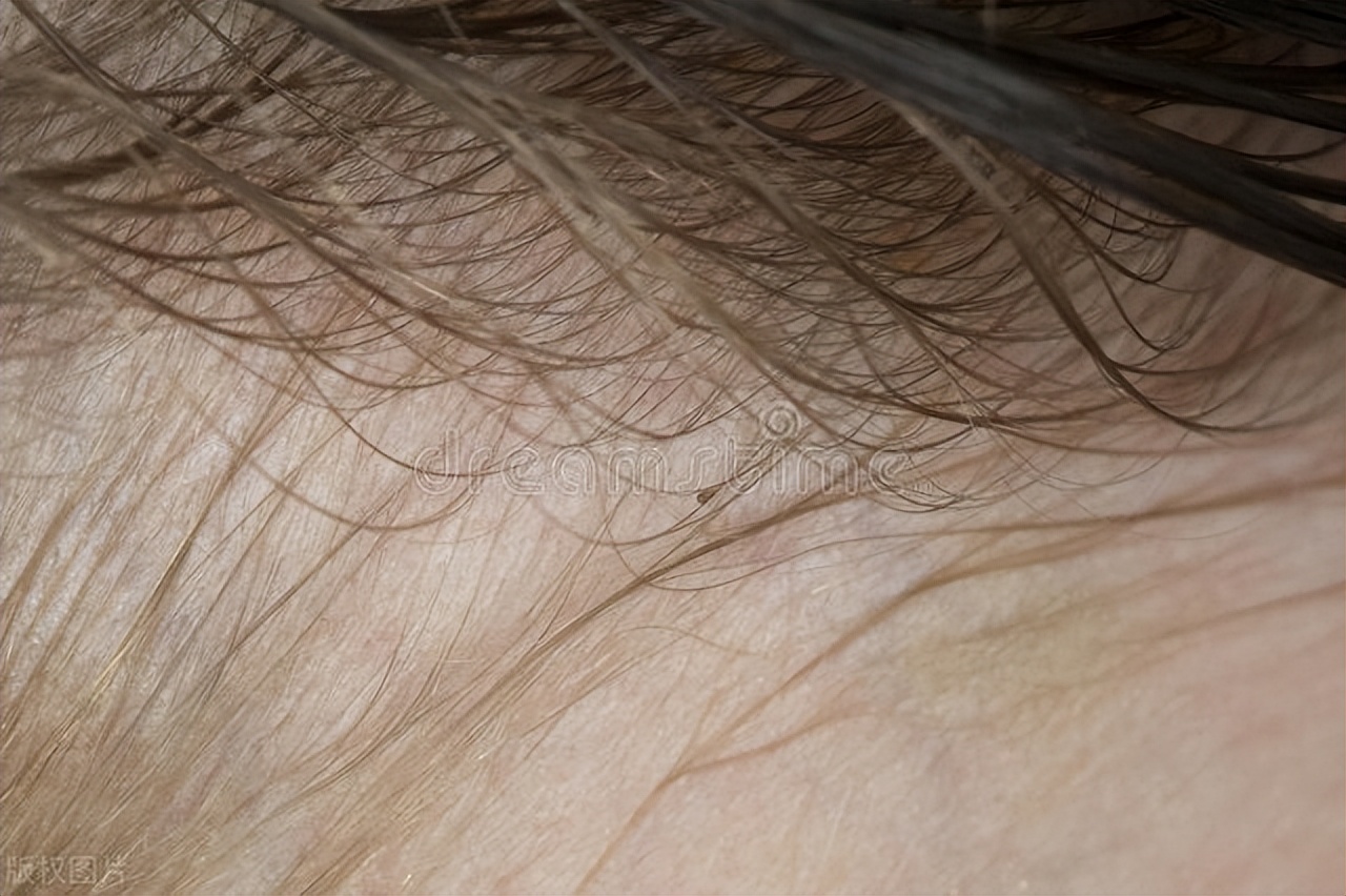 男子阴虱,男子阴虱病