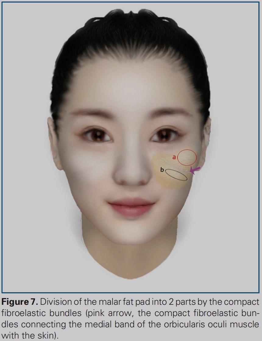 印第安纹解剖学,印第安纹分型对策