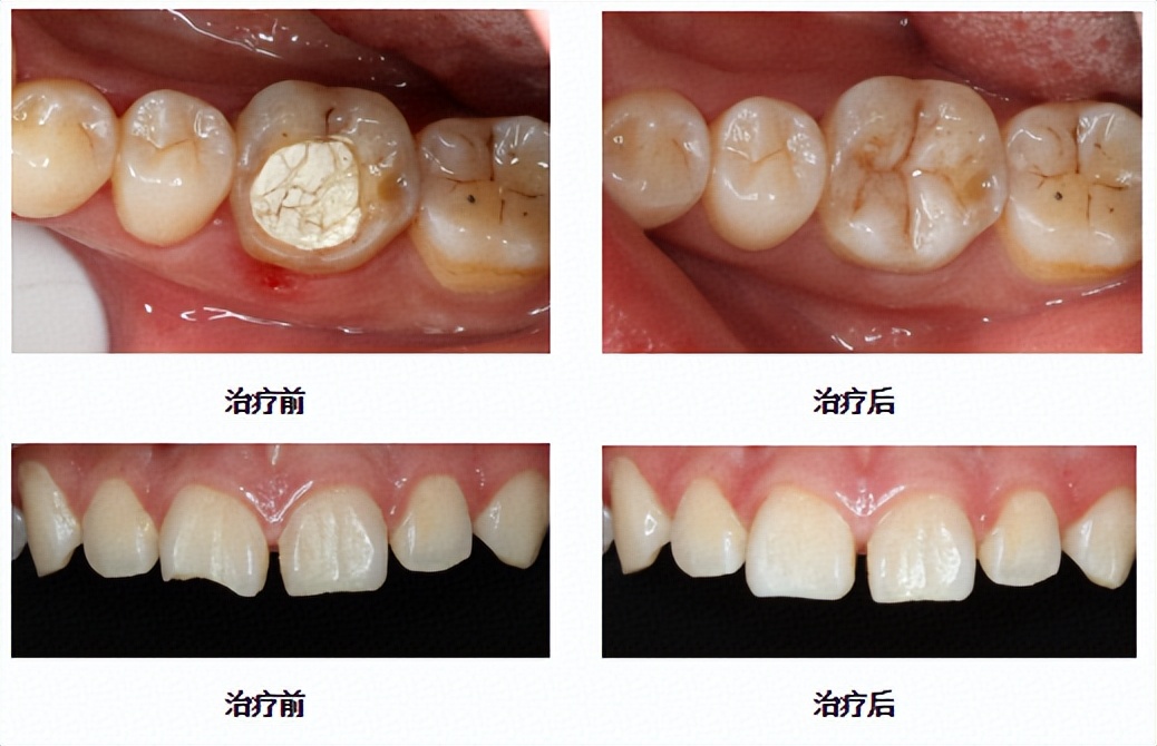 牙齿有蛀牙黑洞怎么办,我的牙齿有洞