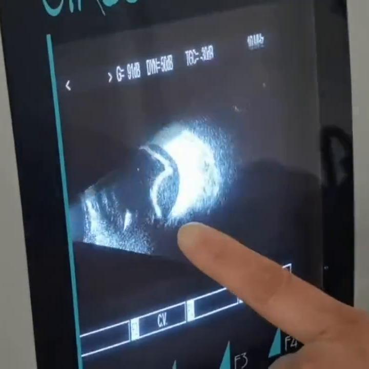 眼底超声检查视网膜裂孔,眼科b超能看出视网膜脱落吗