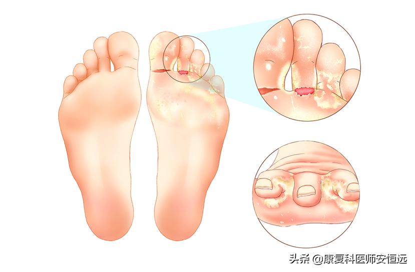 脚气反反复复总是不好是怎么回事,脚气反反复复怎么根治啊