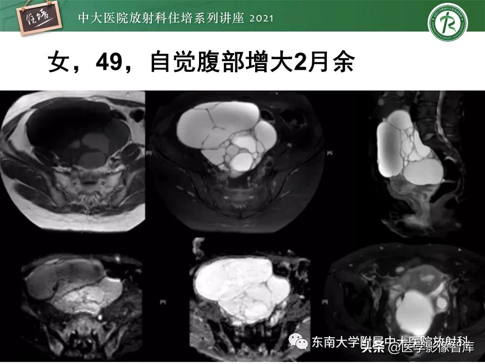 卵巢浆液性肿瘤的肉眼及镜下特征,卵巢原发性粘液性囊腺瘤