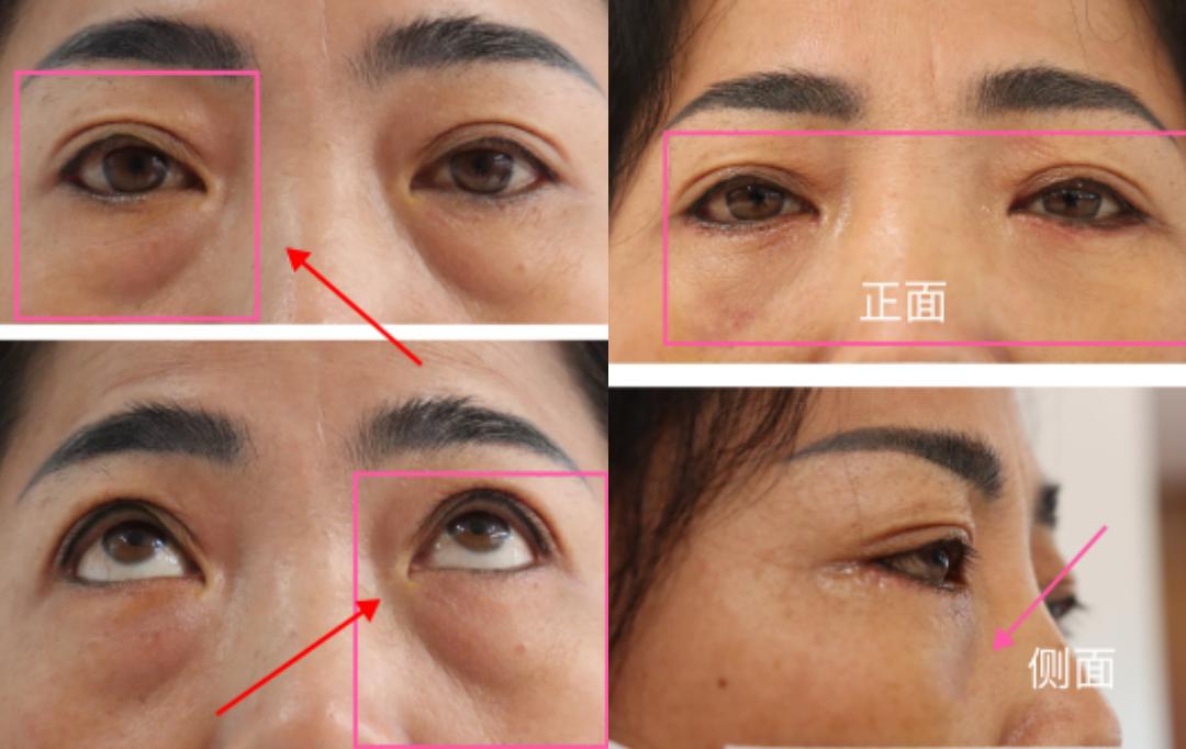 眼袋和卧蚕到底怎么区分,怎么分清眼袋和卧蚕的区别图解