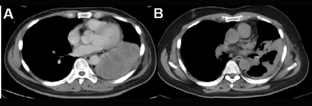肺癌靶向治疗能续命多久,非小细胞肺癌晚期免疫治疗活多久