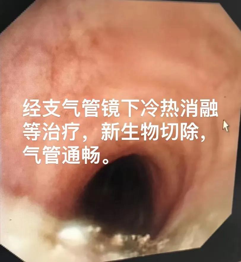 上气道狭窄治疗,气道狭窄致命吗