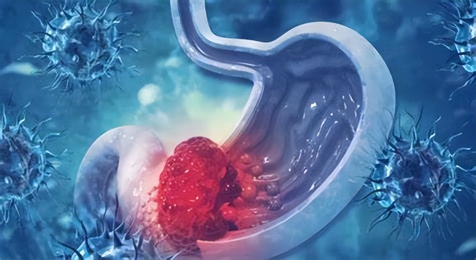 得了胃癌把胃切掉还能活几年,胃癌把胃全切了以后怎么吃饭