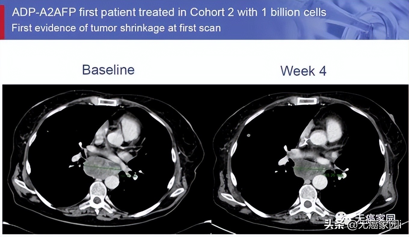肝癌的防治干预计划,肝癌患者免疫治疗需长期治疗吗