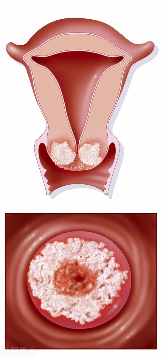 尖锐性湿疣全部症状,尖锐性湿疣各个时期的症状