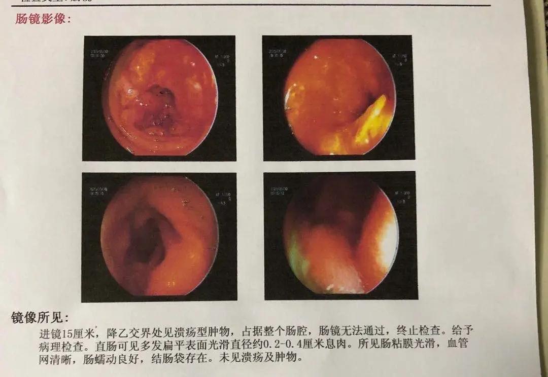 溃疡性结肠炎，大便粘液便血，经典方化解未发作！