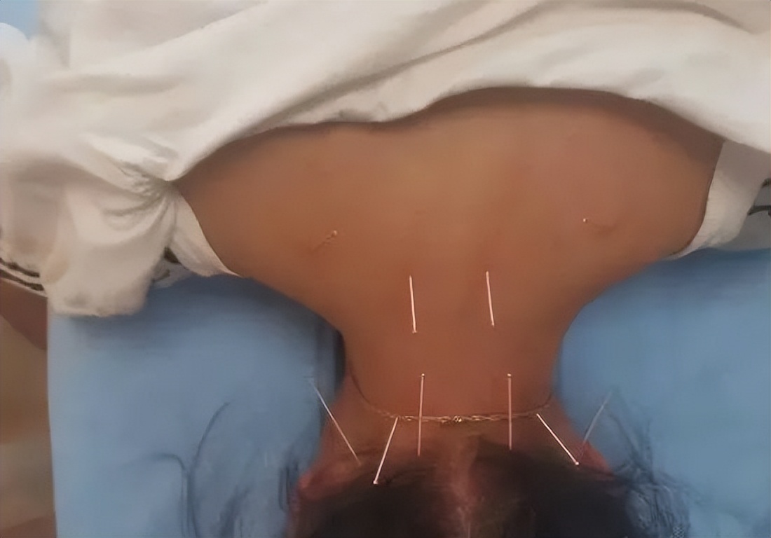 针刺放血哪些穴位治疗失眠,针刺放血治疗失眠吗