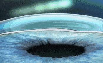 南阳南石眼科医院激光手术多少钱,南阳南石全飞秒近视手术价格