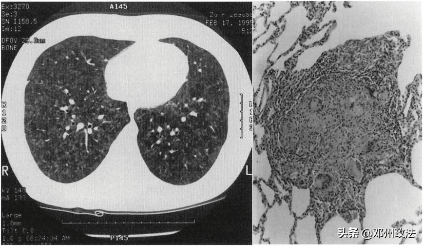 56岁大叔治病,老人肺炎用激素能治愈吗