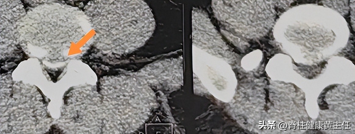 腰椎盘突出臀骨与大腿连接处疼痛,腰间盘突出臀部疼痛脚麻怎么治疗