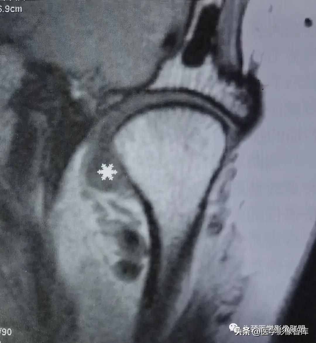 颞下颌关节移位怎么处理,颞下颌关节盘变形怎么治疗