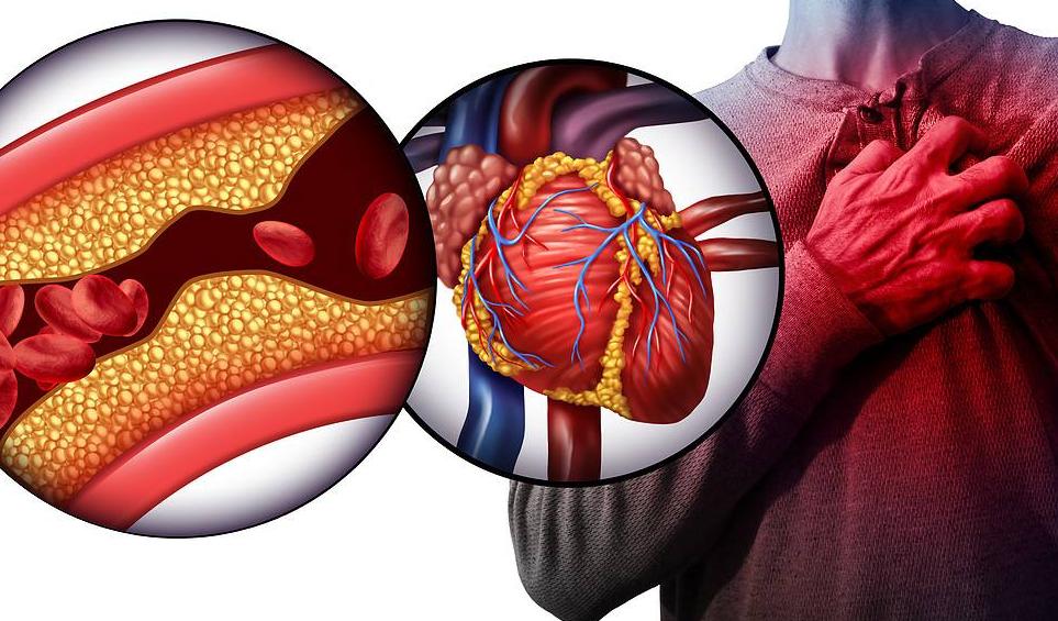心梗急救药有吗,心梗急救用救心丸还是硝酸甘油