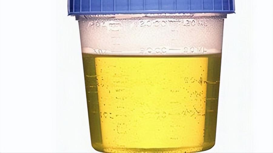 肾脏验血和彩超没问题尿有泡沫,尿里有泡沫是豆类惹的祸吗