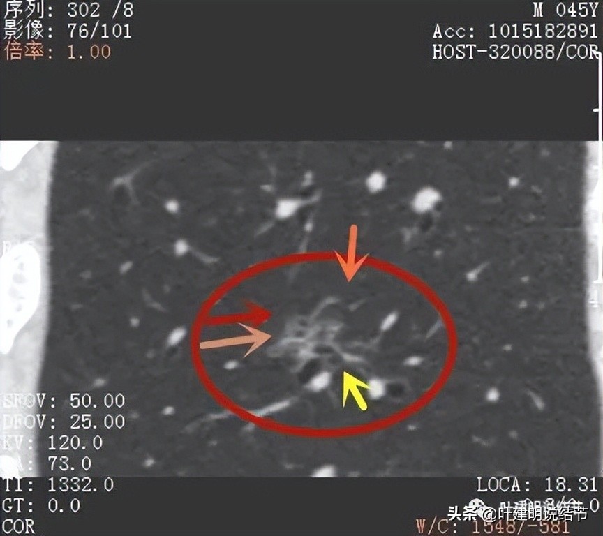 误诊肺纤维化,肺蜂窝状是癌吗