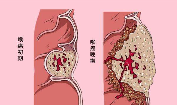 最适合放疗的癌症,哪种肿瘤需要放疗