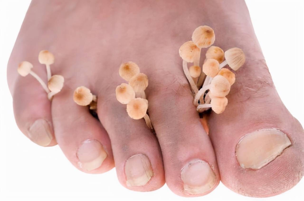 脚气治不断根怎么办呢,脚气真菌在鞋袜上如何彻底消除