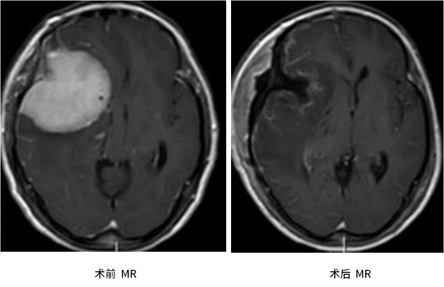 脑肿瘤单眼视力下降,老年人视力下降眼下有黄斑