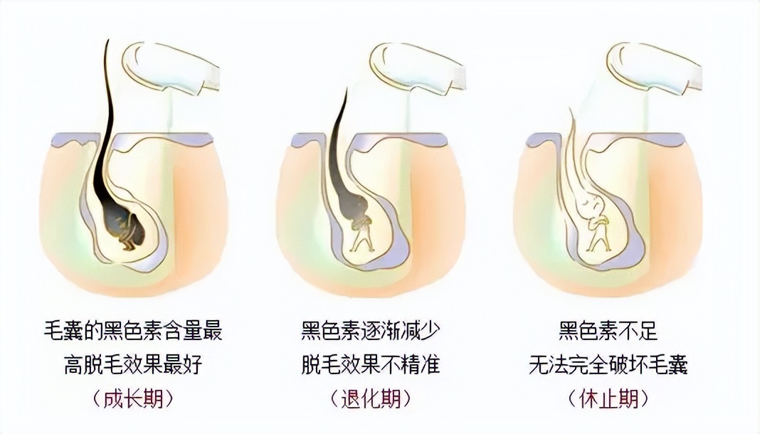 阴毛变白，暗示性功能减退了？或意味着体内有疾病？医生告知真相