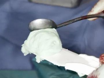 大腿骨折能不能用骨水泥粘住,神奇骨水泥