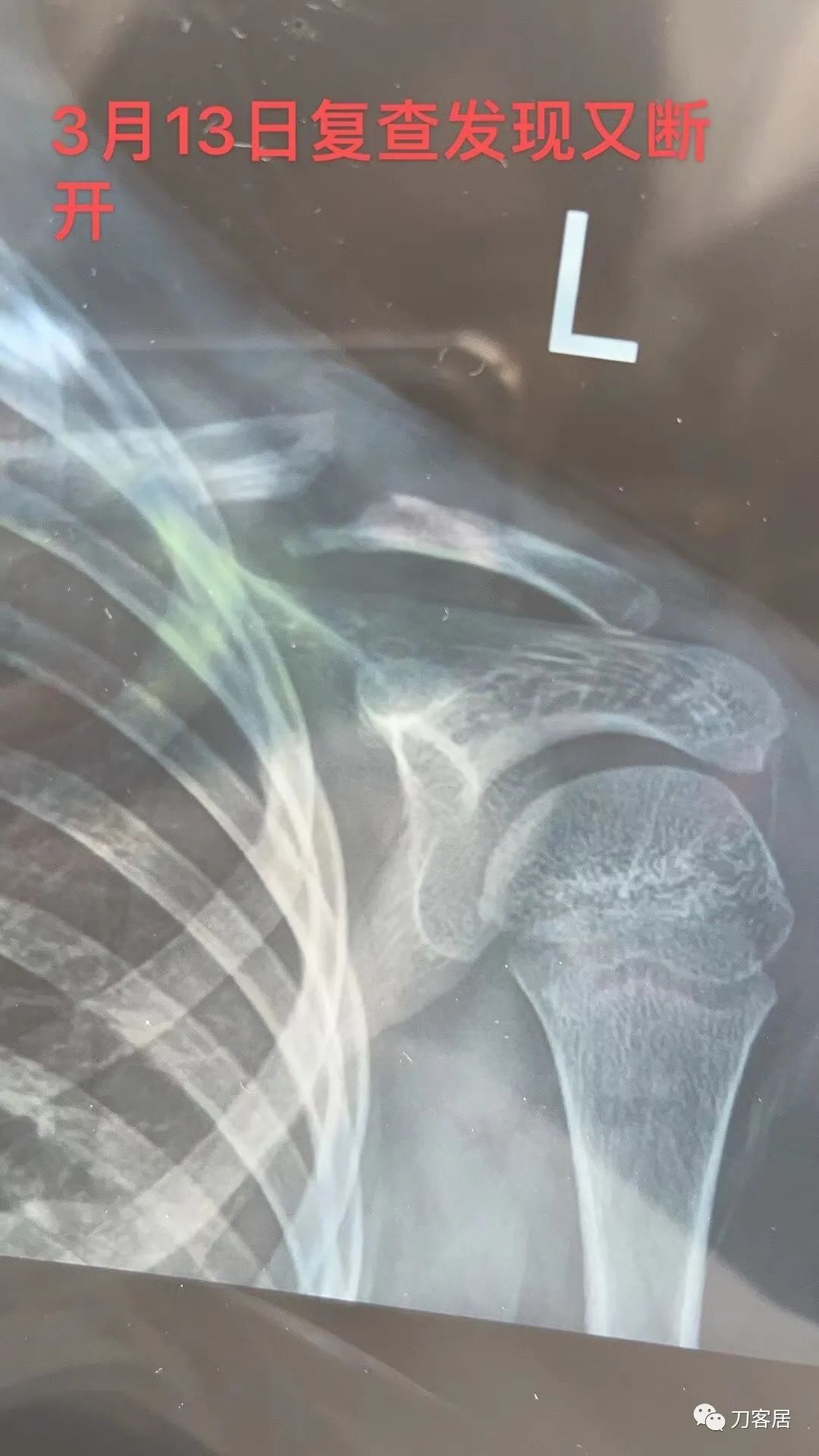 儿童锁骨骨折保守治疗的弊端,锁骨粉碎骨折错位不处理会愈合吗