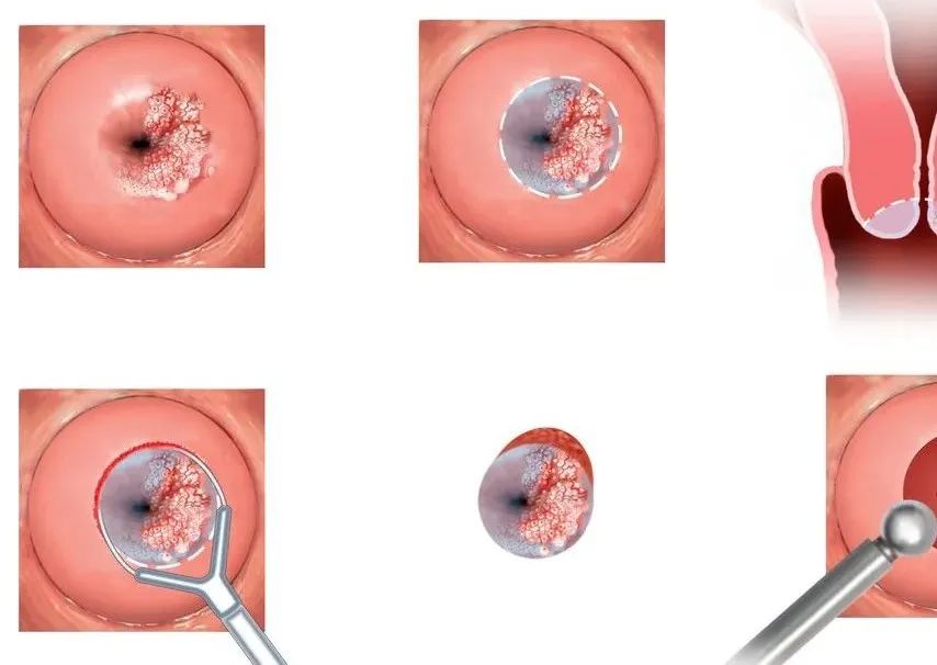 特别严重的宫颈炎该怎么办,宫颈炎到底要怎么预防啊