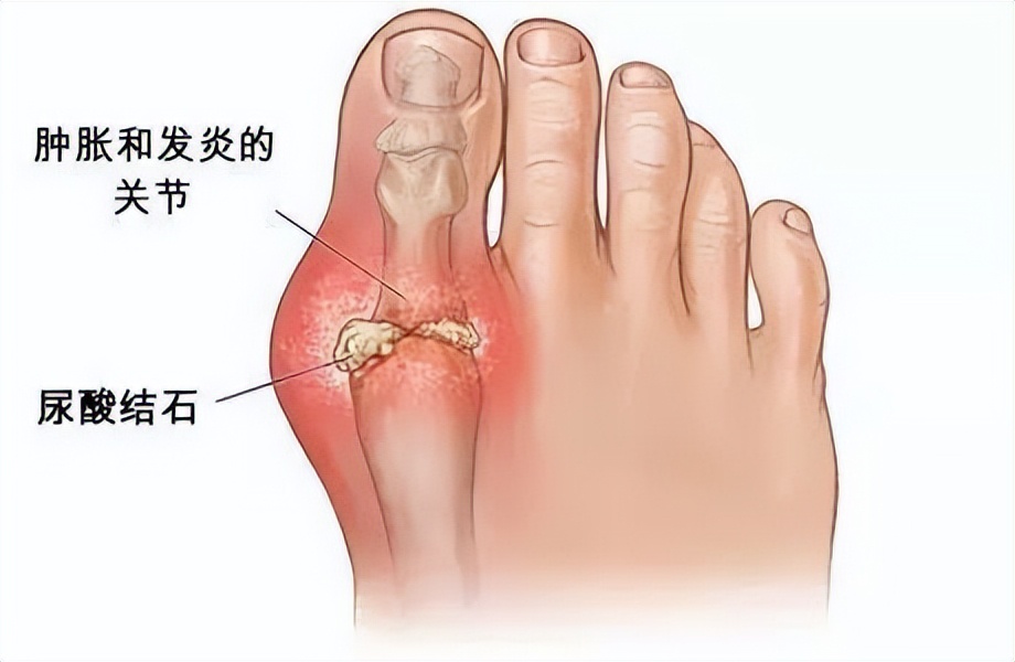 痛风目前最好的治疗方法,痛风分四期如何治疗