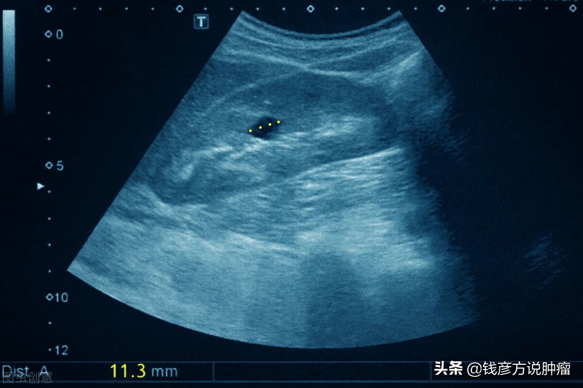 有很多中医治疗肾病真的能治好吗,中草药治肾病有哪些