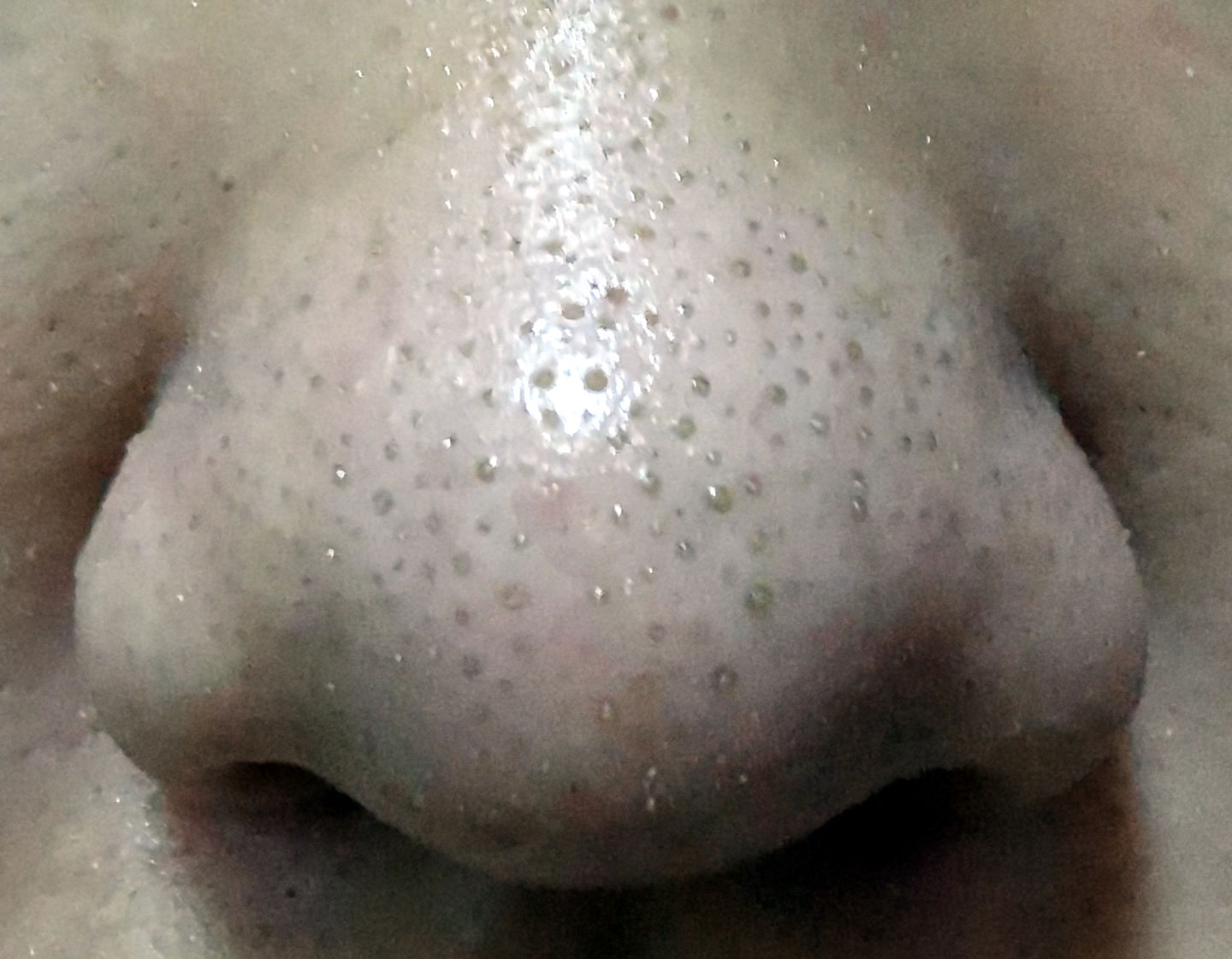 为什么鼻子可以挤出很大的黑头,用夹子挤出鼻子黑头