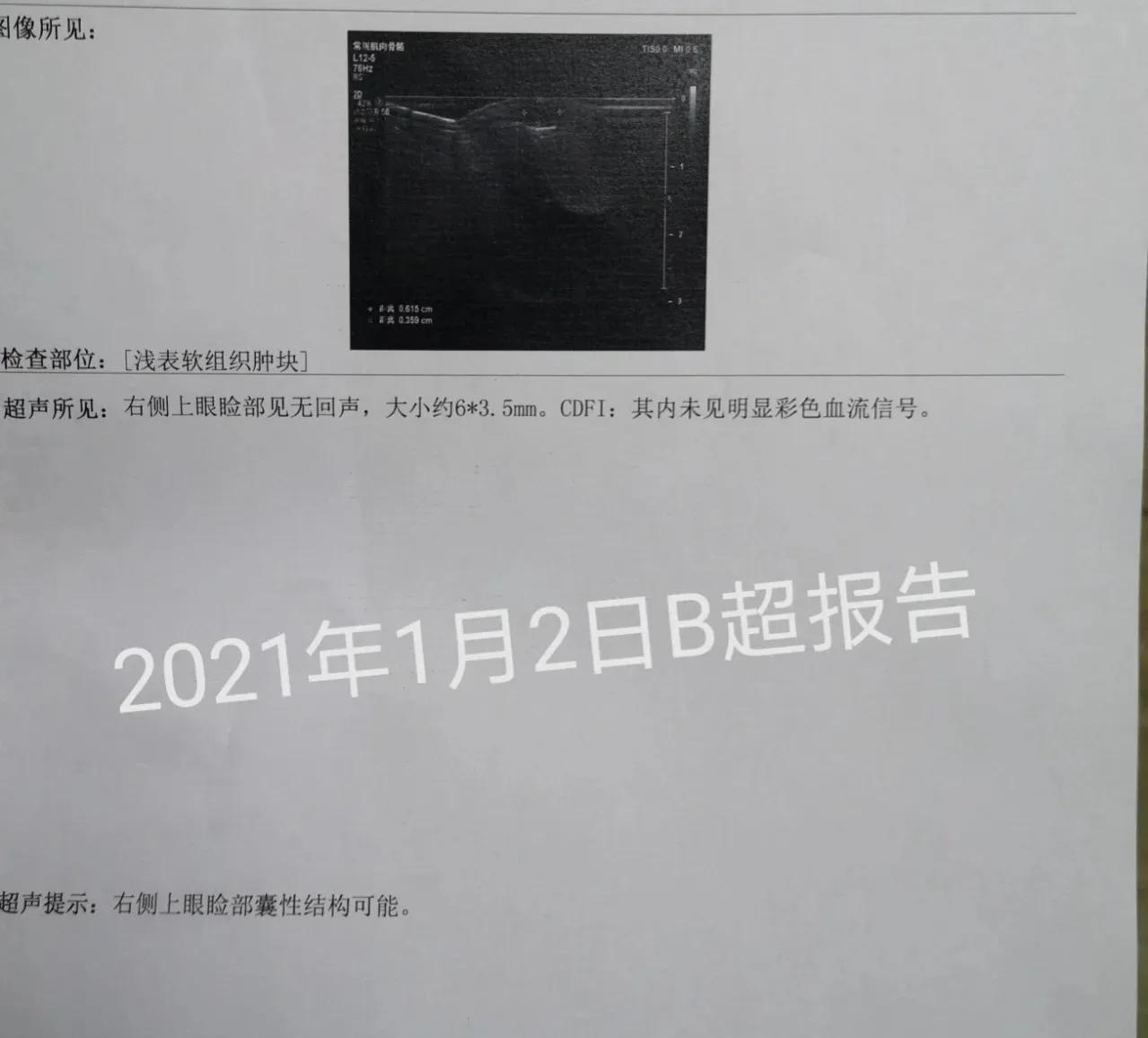 皮脂腺囊肿挤出囊袋,皮脂腺囊肿切除手术