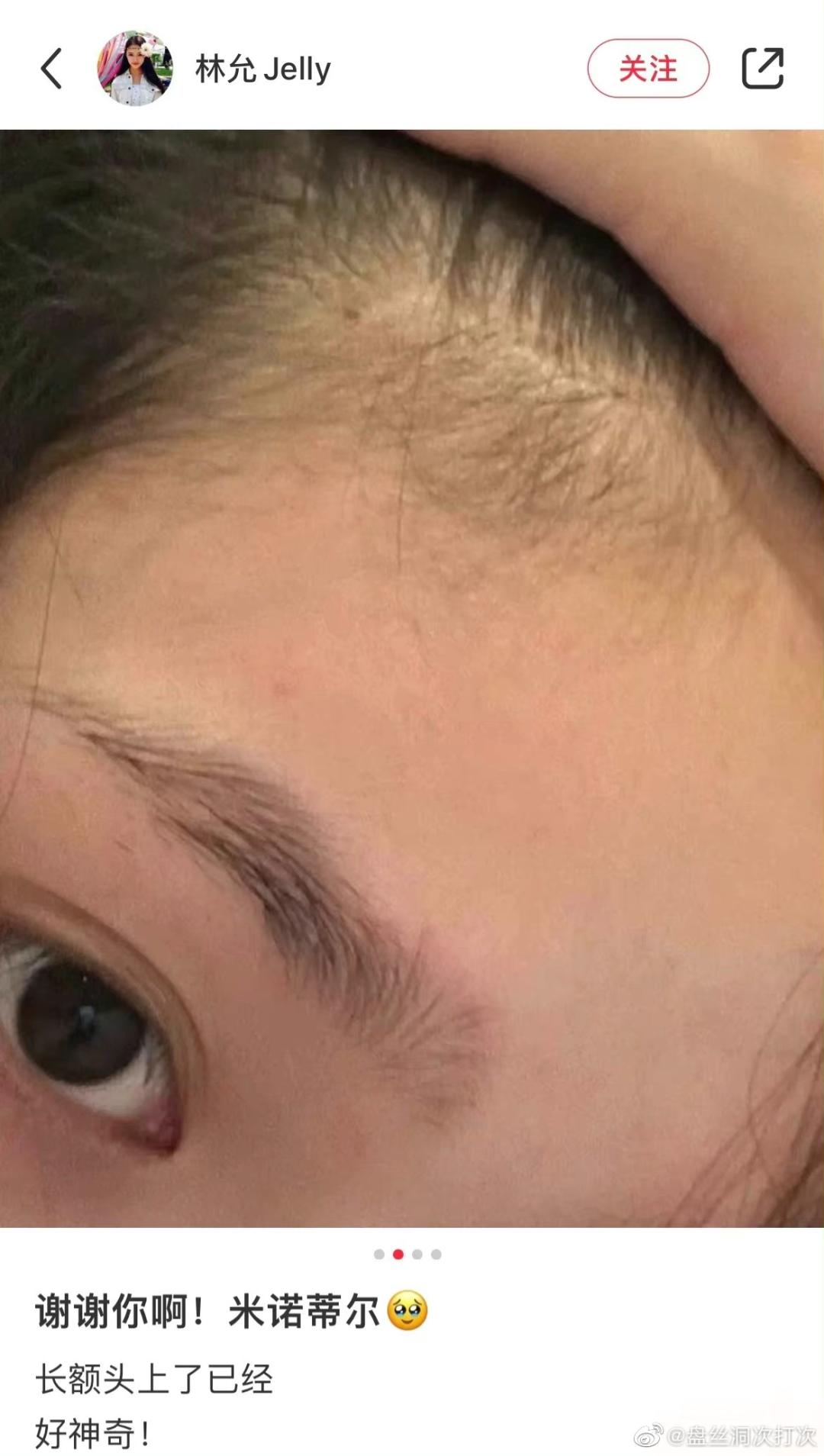 林允防脱发产品,林允同款米诺地尔生发液