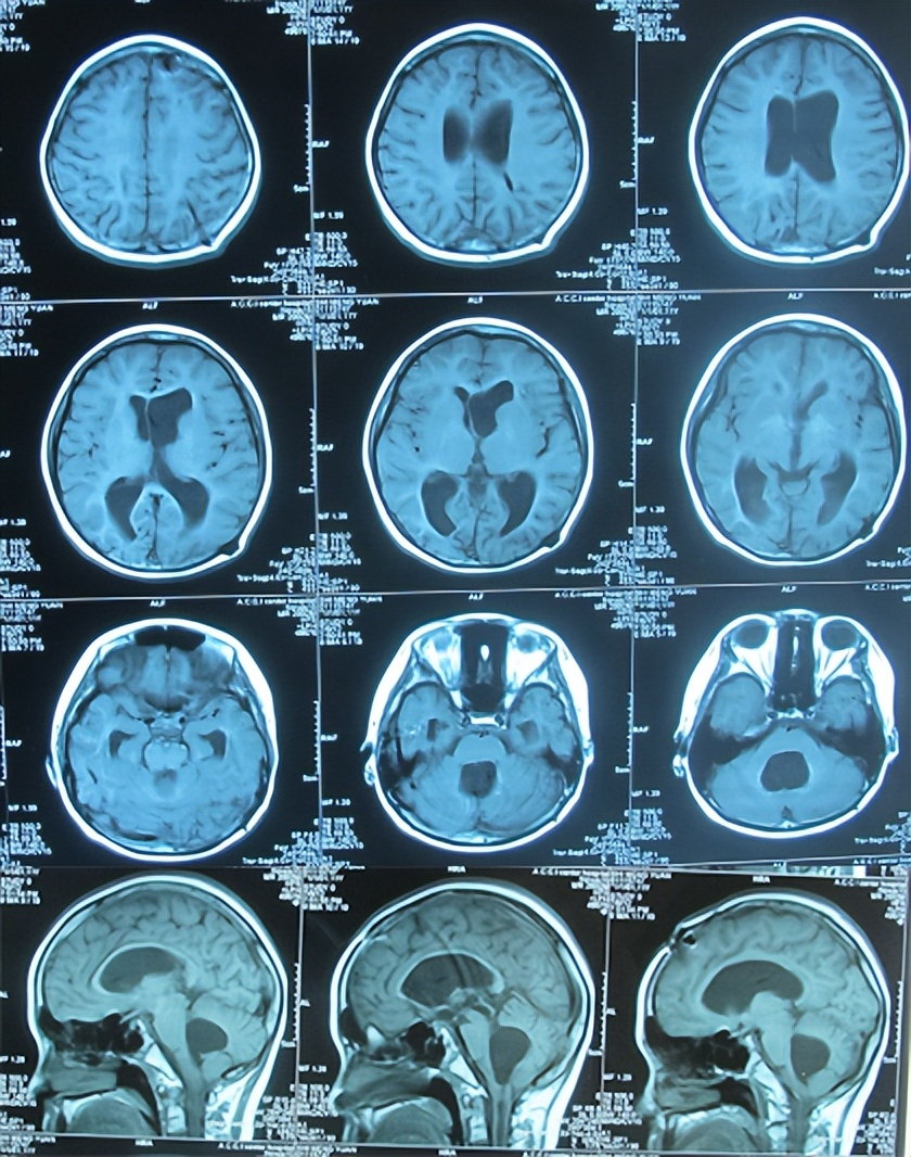 儿童结核脑膜炎脑积水,结核性脑膜炎脑积水如何引起