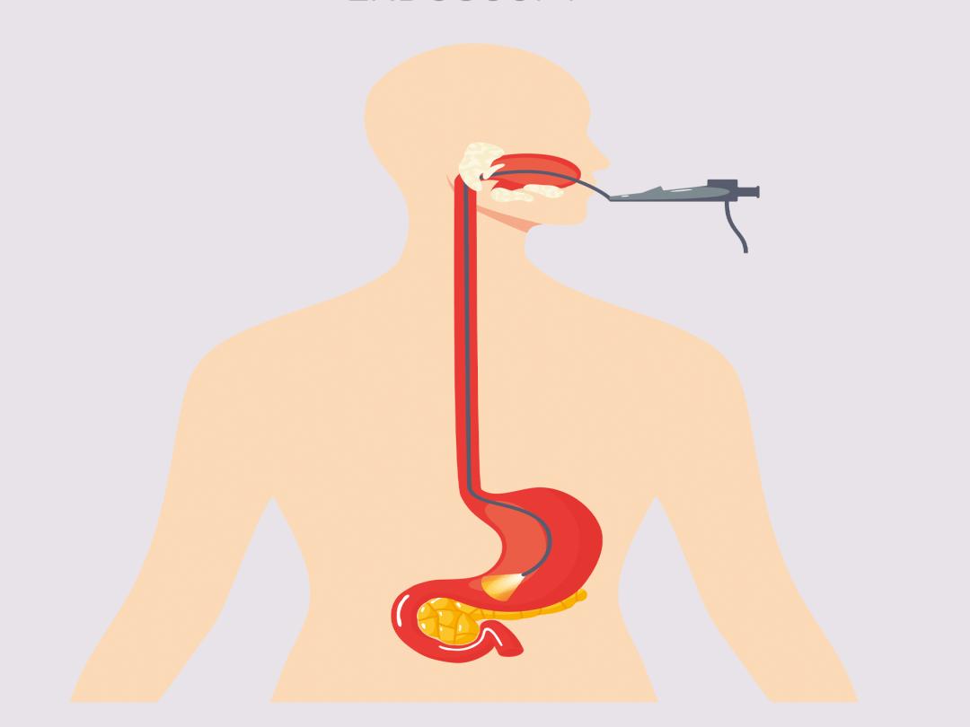 无痛胃镜与普通胃镜的区别是什么,普通胃镜与无痛胃镜的区别